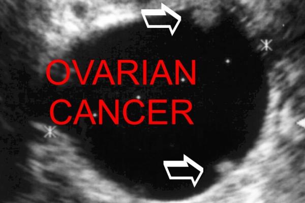 Ovarian%20Cancer%20ultrasound.jpg