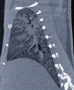 MRISC Lung Image