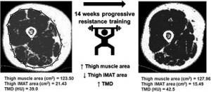 Figure Legend: Cross-sectional mid-thigh region depicting intermuscular adipose tissue (IMAT), subcutaneous fat, skeletal muscle area (gray), and thigh muscle density (TMD).