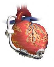 ventricular assist device